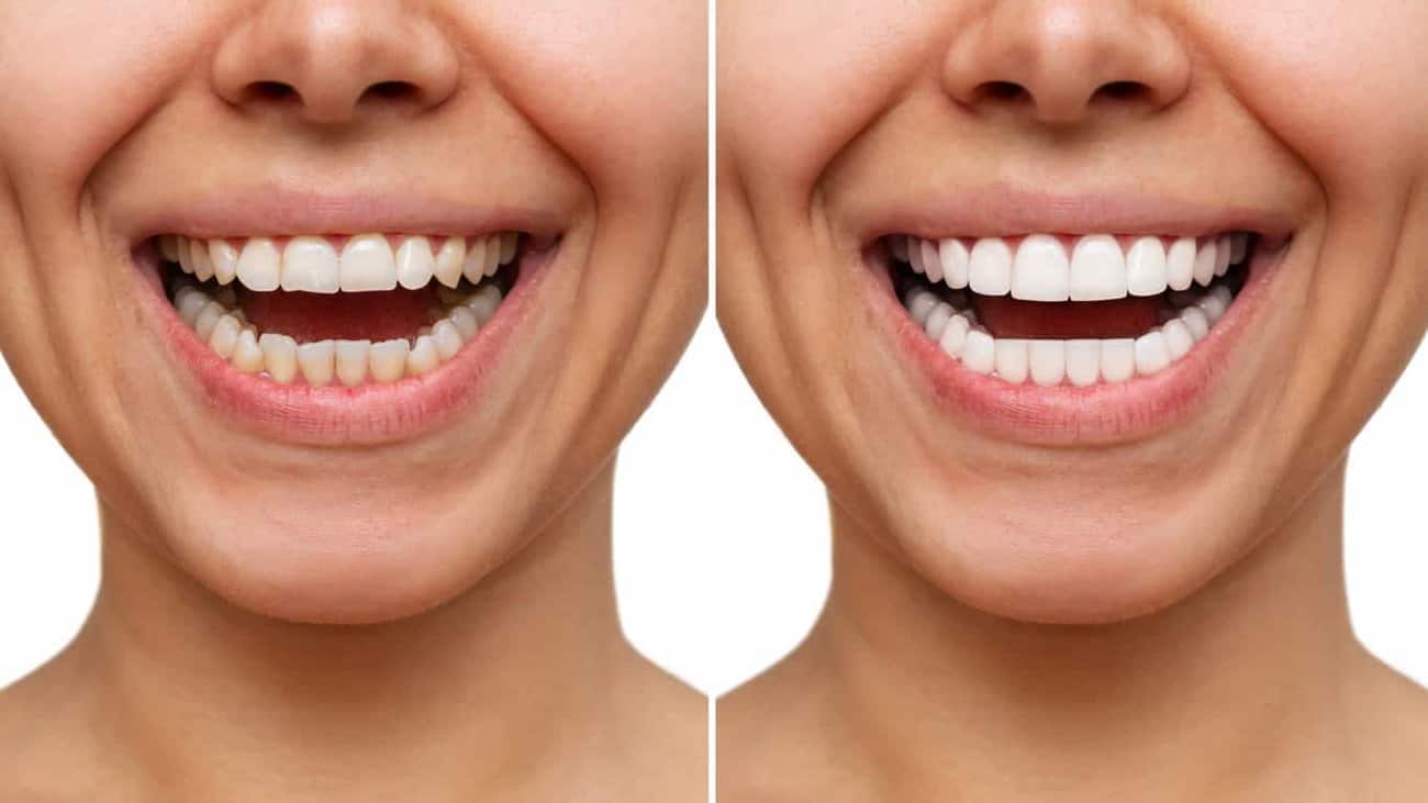 Contact Aspire White for teeth whitening services – Get in touch with Sutton Coldfield today