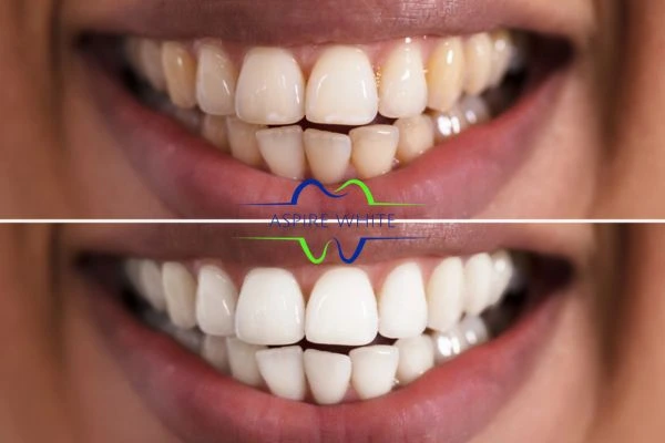 Aspire White customer before and after Sutton Coldfield results.