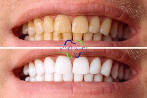 Get noticeable whiter smile in just one hour! Book your teeth whitening treatment Sutton Coldfield today!